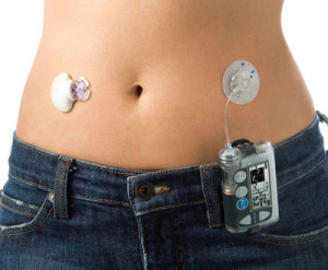 CGMS (Continuous Glucose Monitoring System)