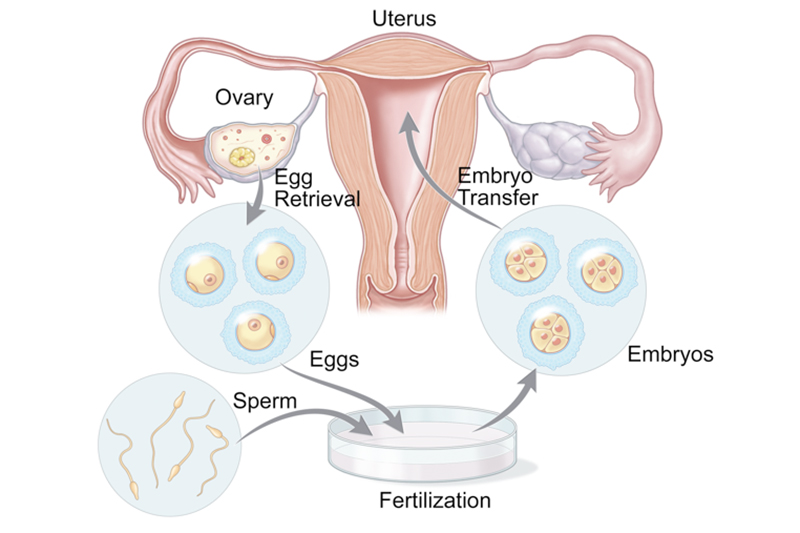 In vitro fertilization for female infertility