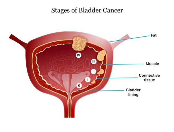 Urinary bladder cancer