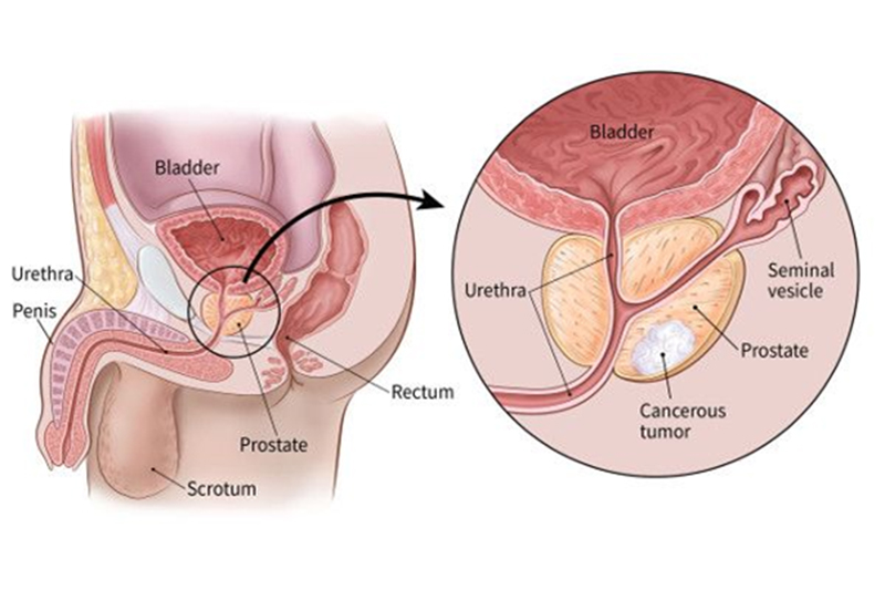 What is Prostate Cancer?